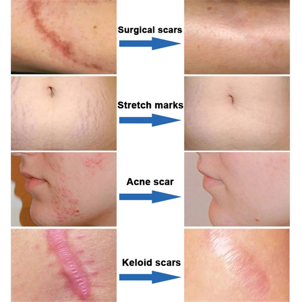 Scar Removal Cream Gel Remove Acne Spots Treatment Stretch Marks Burn Surgical Scar Repair Cream Smoothing Whitening Skin Beauty