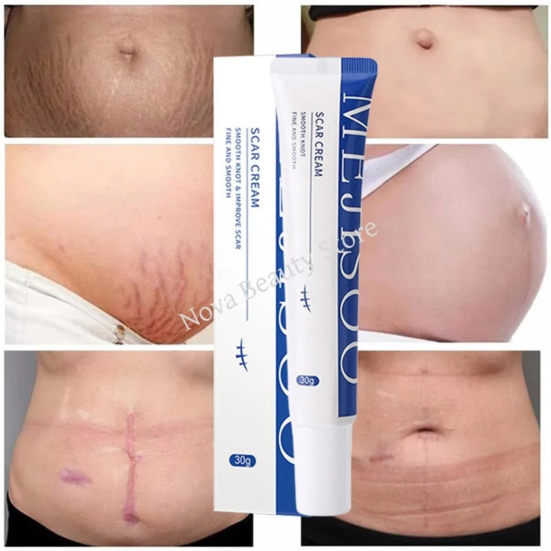 Scar Removal Cream Gel Remove Acne Spots Treatment Stretch Marks Burn Surgical Scar Repair Cream Smoothing Whitening Skin Beauty