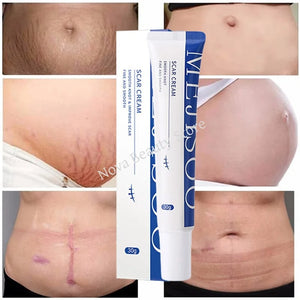 Scar Removal Cream Gel Remove Acne Spots Treatment Stretch Marks Burn Surgical Scar Repair Cream Smoothing Whitening Skin Beauty