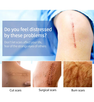 Scar Removal Cream – Acne, Stretch Marks & Whitening