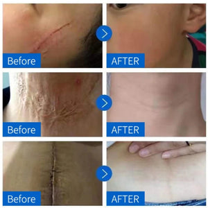 Scar Removal Cream Gel Remove Acne Spots Treatment Stretch Marks Burn Surgical Scar Repair Cream Smoothing Whitening Skin Beauty