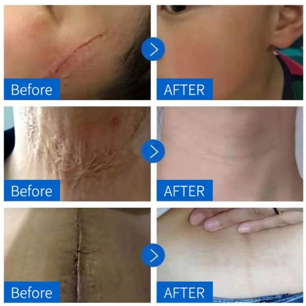 Scar Removal Cream Gel Remove Acne Spots Treatment Stretch Marks Burn Surgical Scar Repair Cream Smoothing Whitening Skin Beauty