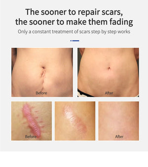 Scar Removal Cream Gel Remove Acne Spots Treatment Stretch Marks Burn Surgical Scar Repair Cream Smoothing Whitening Skin Beauty