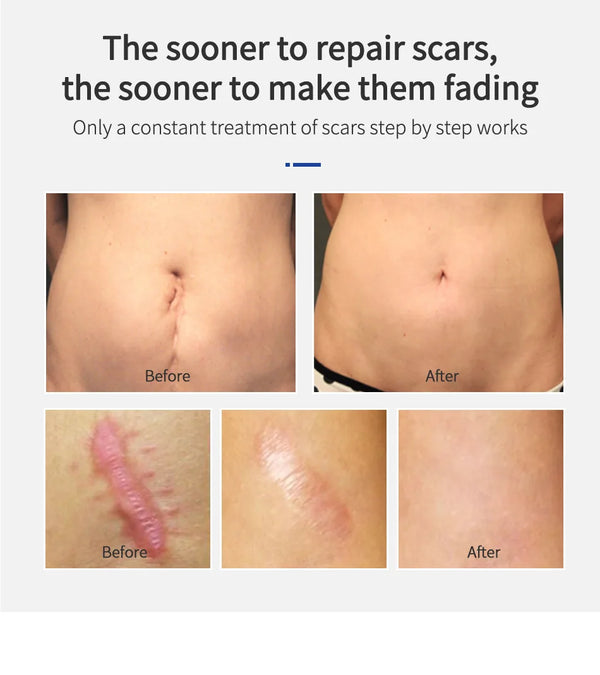 Scar Removal Cream Gel Remove Acne Spots Treatment Stretch Marks Burn Surgical Scar Repair Cream Smoothing Whitening Skin Beauty