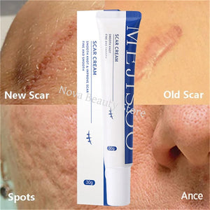 Scar Removal Cream – Acne, Stretch Marks & Whitening