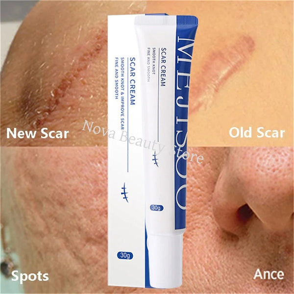 Scar Removal Cream – Acne, Stretch Marks & Whitening