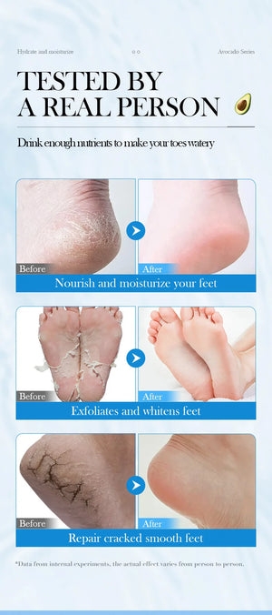 Avocado Foot Exfoliating Mask – Moisturizing Dead Skin Remover (1/3/5 Pairs)