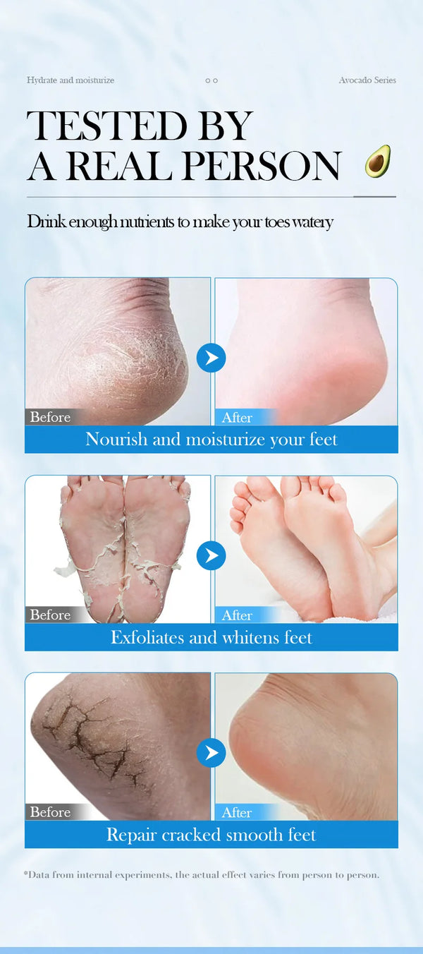 Avocado Foot Exfoliating Mask – Moisturizing Dead Skin Remover (1/3/5 Pairs)
