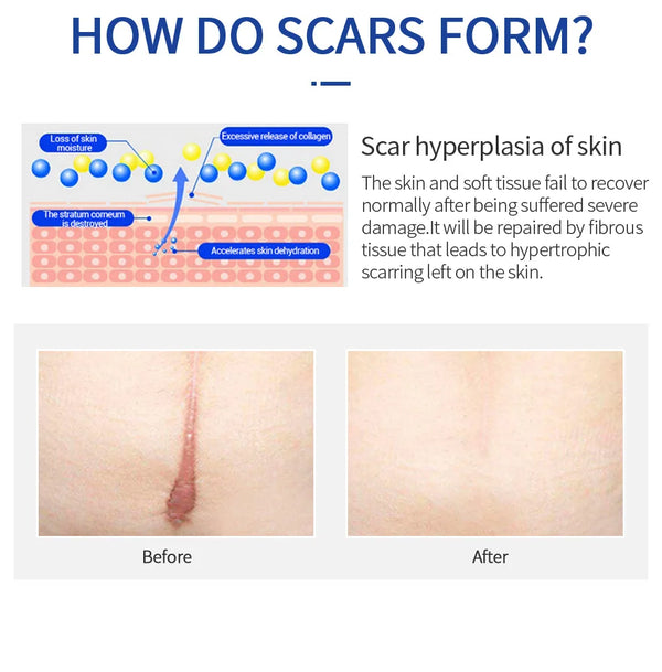 Scar Removal Cream Gel Remove Acne Spots Treatment Stretch Marks Burn Surgical Scar Repair Cream Smoothing Whitening Skin Beauty