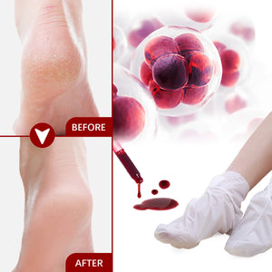 Fruit Acid Foot Exfoliating Mask – 5 Pairs Moisturizing Dead Skin Remover