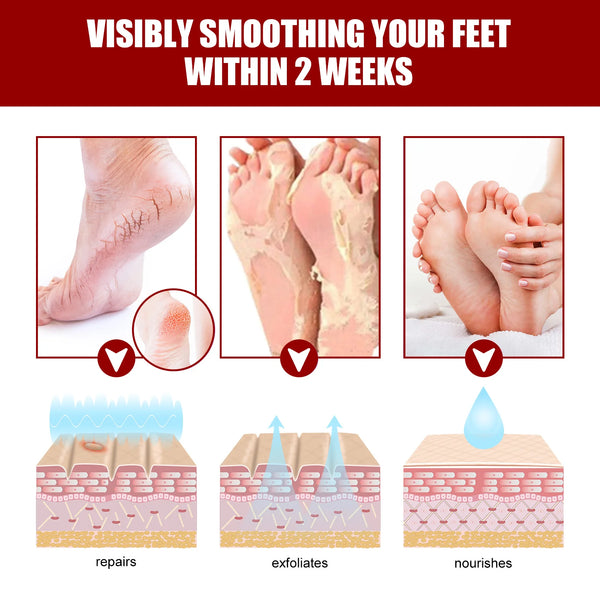 Fruit Acid Foot Exfoliating Mask – 5 Pairs Moisturizing Dead Skin Remover